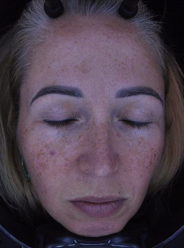 Twarz klientki na chwilę przed zabiegiem.