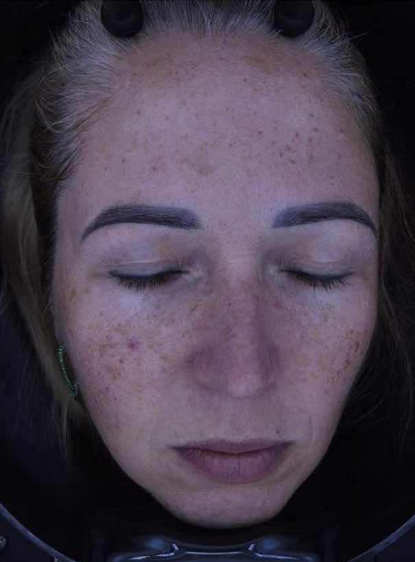 Twarz klientki zaraz po zabiegu.